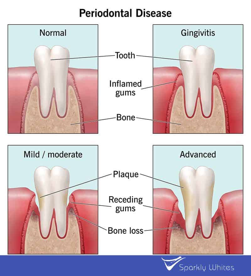 Can Gum Bleeding Really Indicate Poor Oral Hygiene Blackburn?