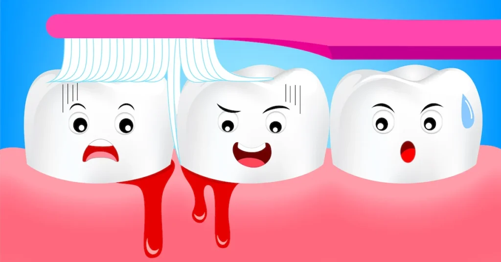 Is Bleeding Gums an Early Sign of Gum Disease Blackburn?