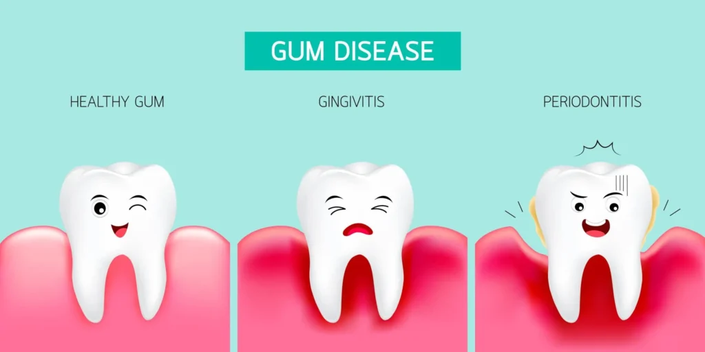 Advice for Gum Health