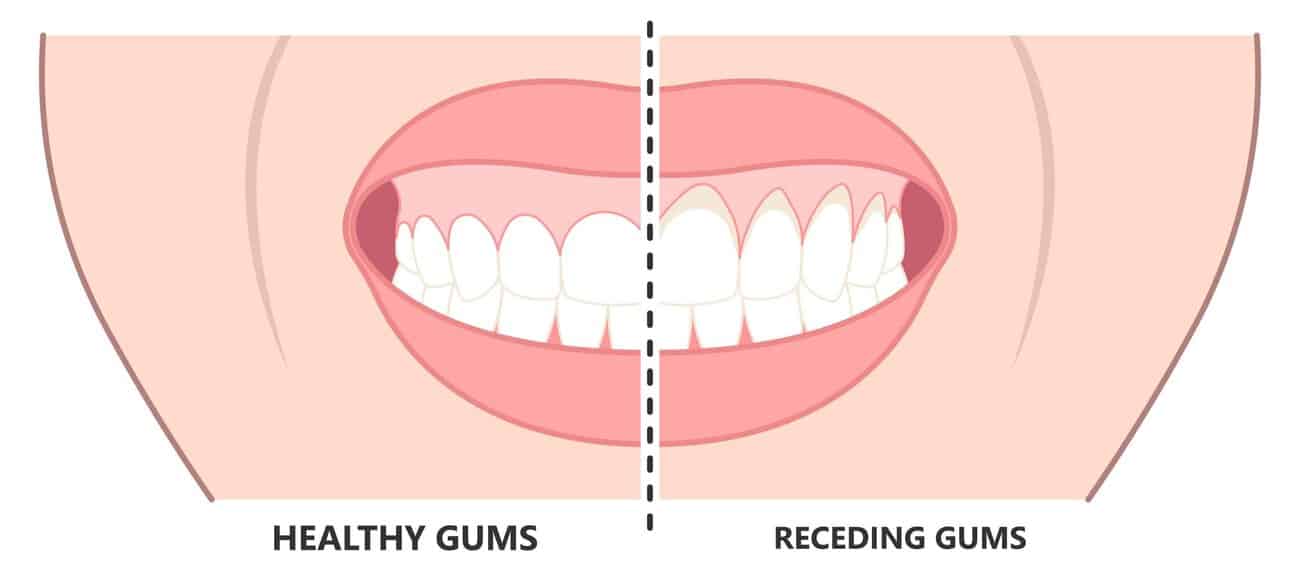 What Causes Gums to Recede Over Time Blackburn