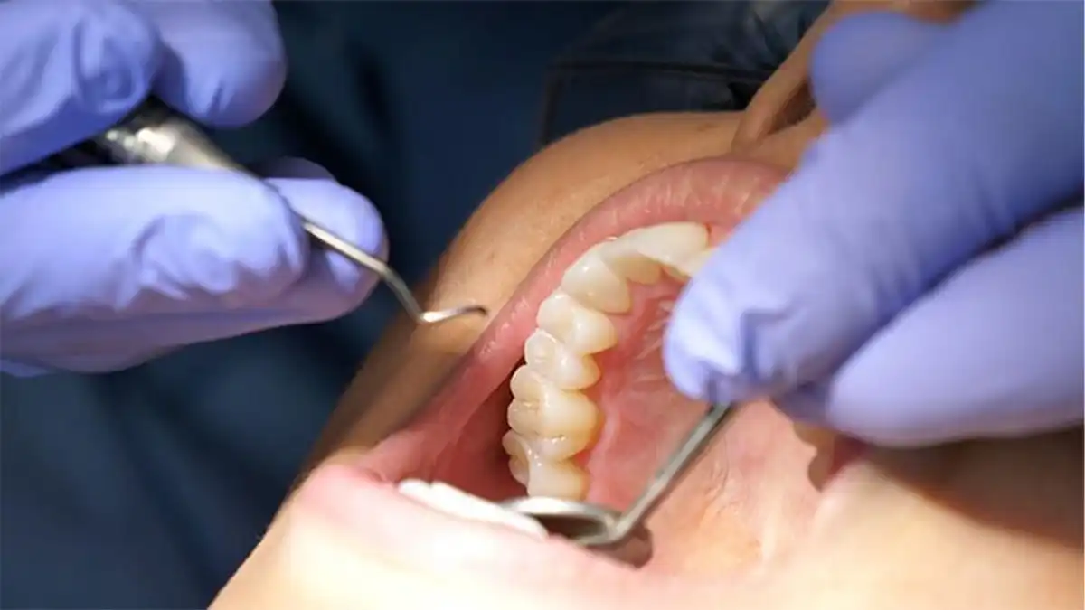 What's The Actual Difference Between Laser and Tray Teeth Whitening—And Why Should You Give a Floss Blackburn?